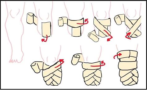 News After Below Knee Amputation How To Do Stump Bandaging