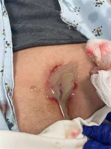 What Came Out Of My Infected Pilonidal Cyst Nudes Popping Nude