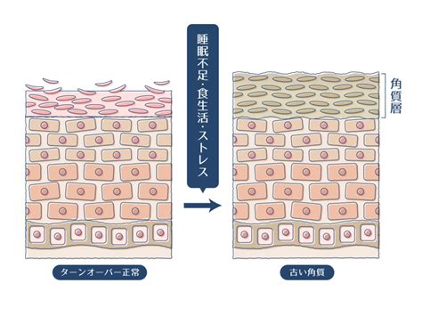 角栓の正しい取り方を徹底解説！ng行動やおすすめのクレンジング＆洗顔をチェック ハダメディア By Bihadadotokyo