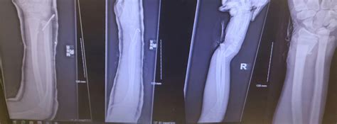 My 12 Year Olds Football Injury From October Rradiology