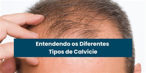 Entendendo Os Diferentes Tipos De Calv Cie Um Guia Completo Para