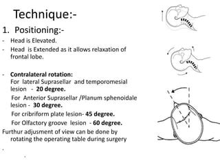 Supraorbital Craniotomy Ppt