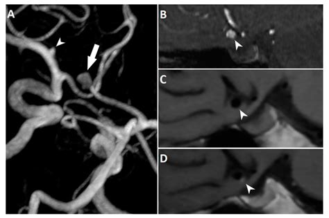 3d Reconstruction Of Tof Mra Showing An Unruptured Anterior