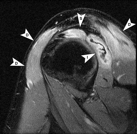 MRI Findings Of 26 Patients With Parsonage Turner Syndrome AJR