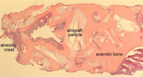 Understanding Sclerotic Bone SteinerBio