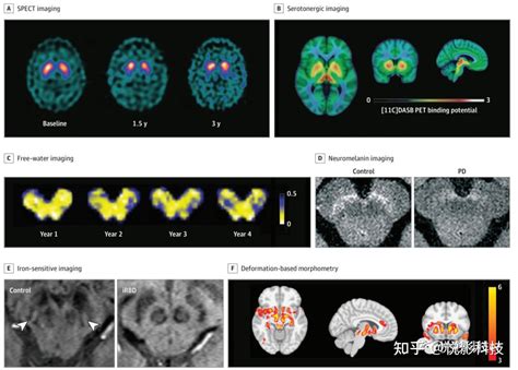 JAMA Neurology帕金森病跨疾病阶段的新兴神经成像生物标记物 知乎