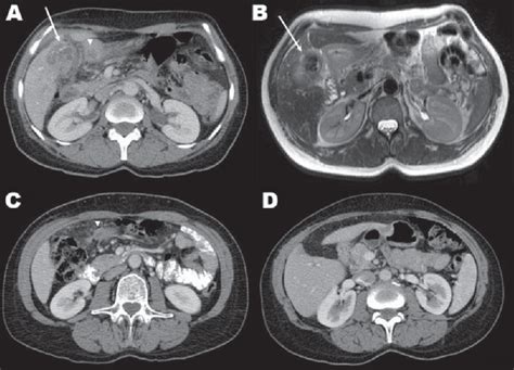 Figure A Contrast Enhanced Computerized Tomography Ct Scan Showing