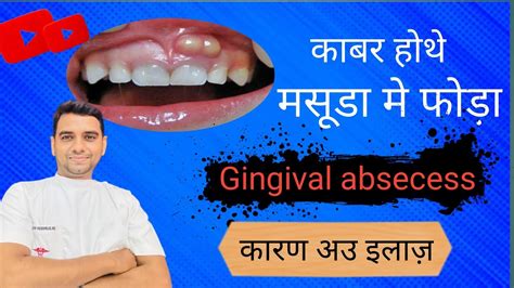 दत और मसड म पस फड कबर हथ और क हथ ओकर ईलज Dental