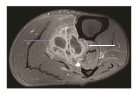 T2 Weighted Fat Saturated Postcontrast Axial MR Image Of Left Calf