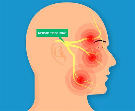 Neuralgia Del Trigémino Dr Radovan Sancevic