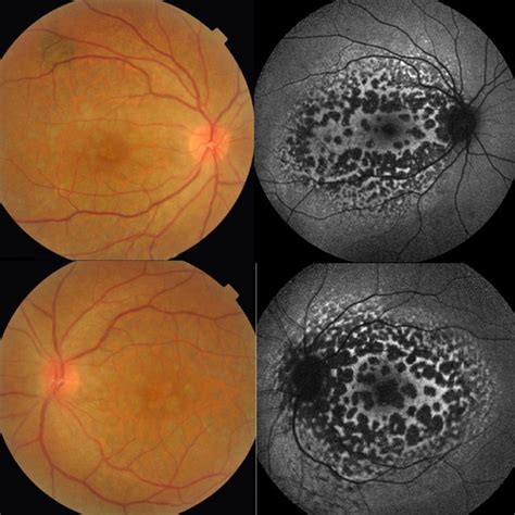 Giraffe Or Leopard Spot Chorioretinopathy As An Outstanding Finding