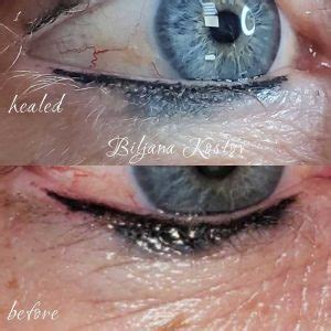 Eyeliner Tattoo Gone Wrong Side Effects Risks And Fixes