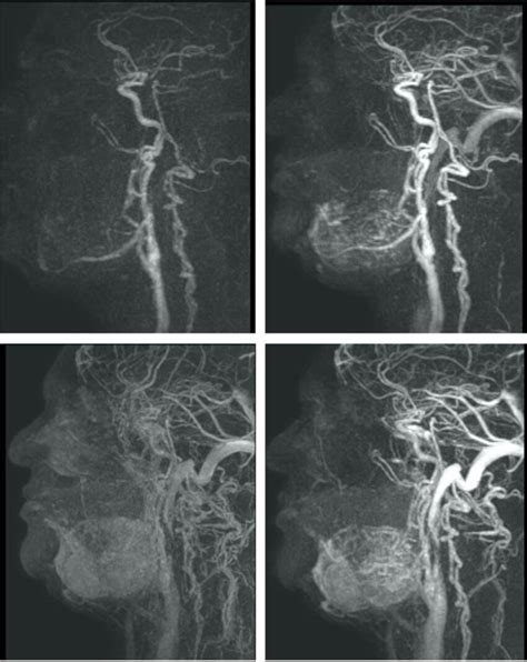 Contrast Enhanced Mra Using Time Resolved Imaging Clockwise From Top