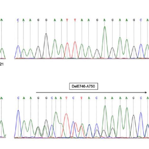 Examples Of EGFR Mutation Positive NSCLC Cases A Patient 1