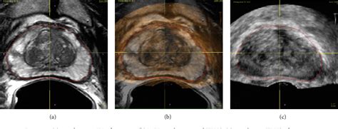 Figure 1 From Multiparametric Mri In Biopsy Guidance For Prostate Cancer Fusion Guided