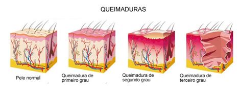 7º Grupamento De Resgate Queimaduras De 1°2° E 3° Grau