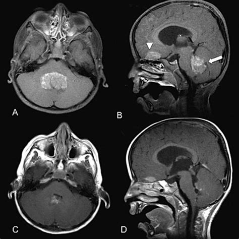 A Axial Magnetic Resonance Imaging T1 Weighted Image With Gadolinium