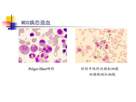 Ppt 再生障碍性贫血 （ Aplastic Anemia Aa ） Powerpoint Presentation Id6155260