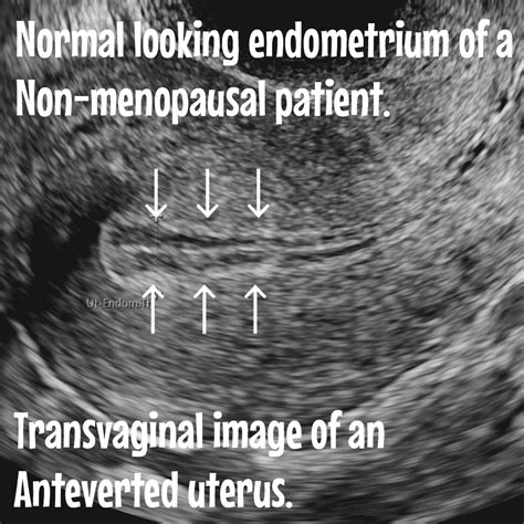 Endometrial hyperplasia. Causes, risks, ultrasound and treatment ...