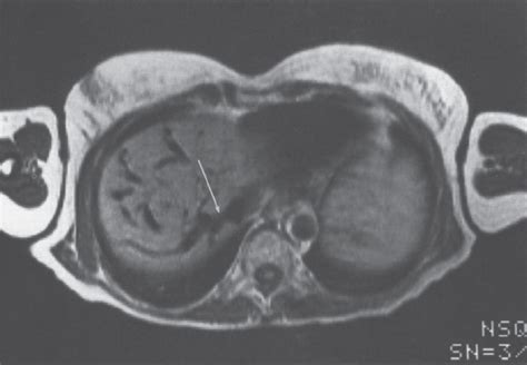 The Budd-Chiari Syndrome | Radiology Key