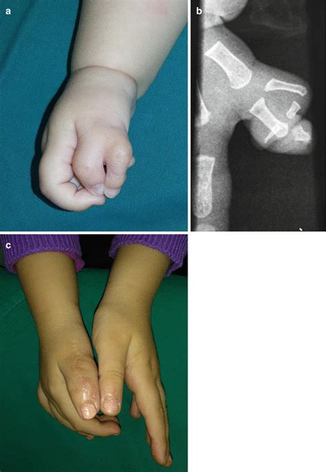 Polydactyly Plastic Surgery Key