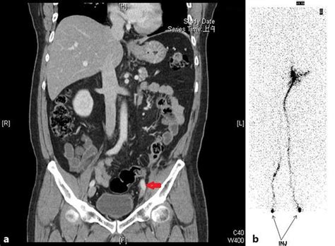 A 51 Year Old Man Had Left Ureteral Urothelial Carcinoma With Download Scientific Diagram