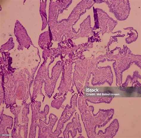 Mature Cystic Teratoma Ovarian Cyst Biopsy Show Cyst Wall Of Skin And