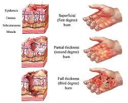 Burn Scars - stemcellreferencestemcellreference