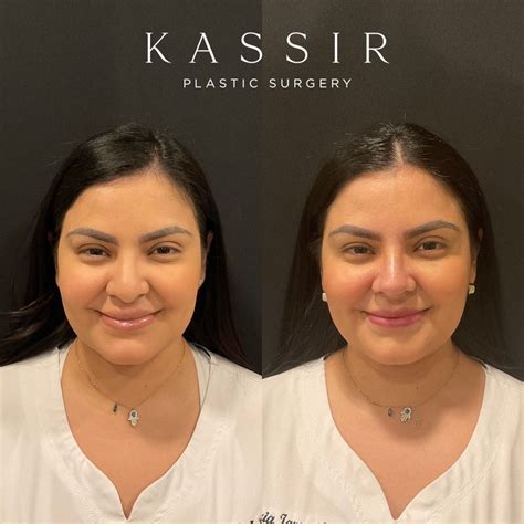 Female Hispanic Rhinoplasty Ethnic Rhinoplasty — Kassir Plastic