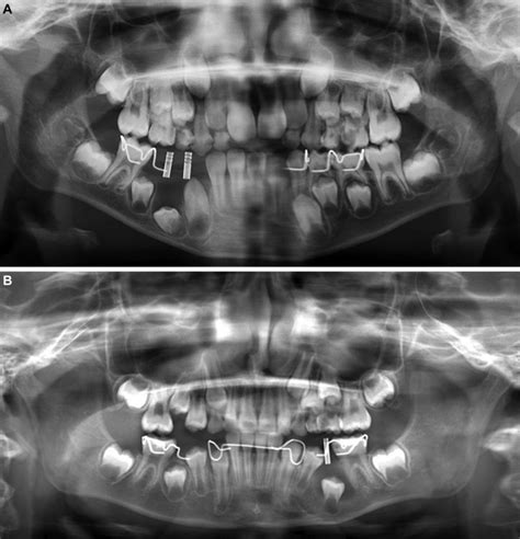 Outcome Of Mandibular Dentigerous Cysts 1 To 10 Years After Decompression Using A Custom Made