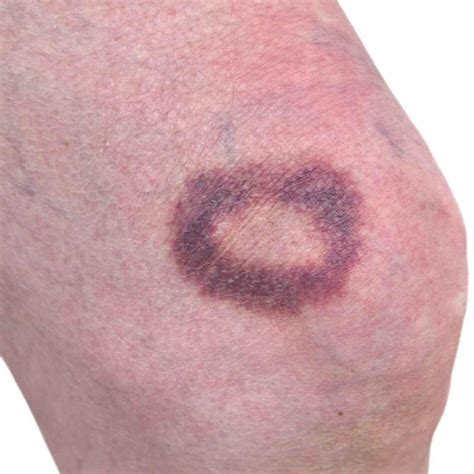 What Is A Hematoma Symptoms, Diagnosis and Treatment