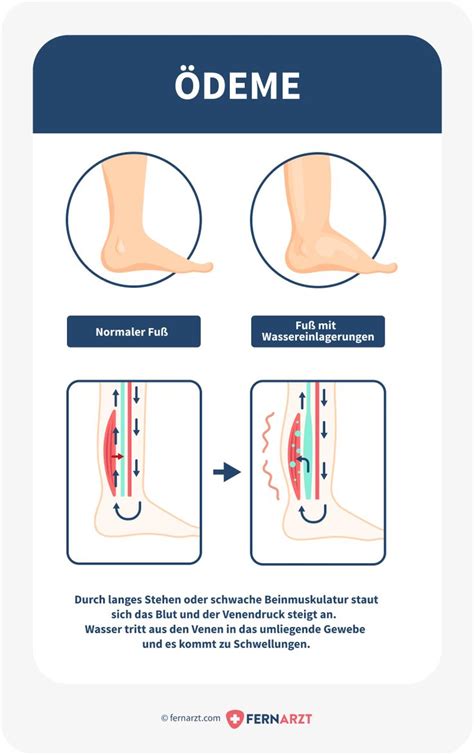 Ödeme Auf was Ihre Wassereinlagerungen hindeuten können Fernarzt