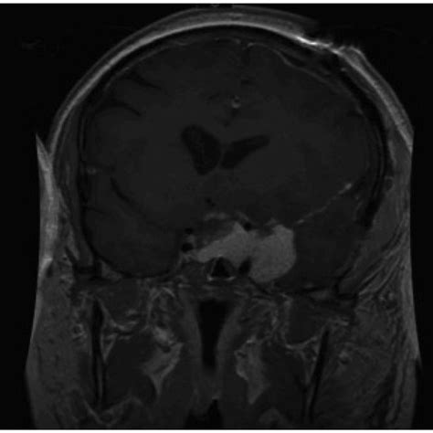 Mri T1 Contrast Demonstrating The Lesion Overlying The Sphenoid Sinus