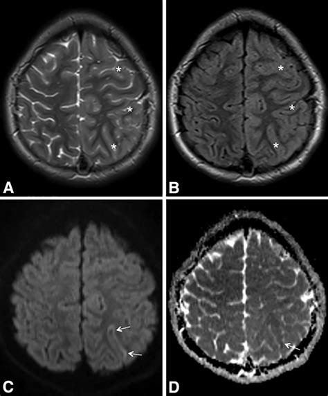 A 14 Year Old Girl Presented With Acute Headache Right Hemiplegia