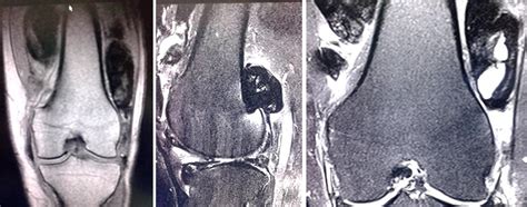 Sinovitis Vellonodular Pigmentada Difusa Dornes Ram N Mediciego