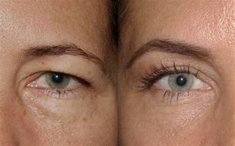 Brow Lift Before And After Artofit