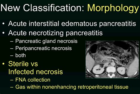 Rsna Acute Pancreatitis