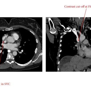 CT Angiography Of The Chest Showing A Filling Defect In The SVC And