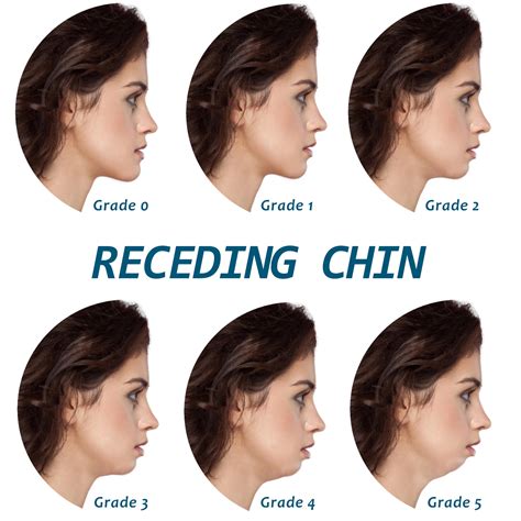 Receding chin and class II malocclusion - Surgical simulator before/after