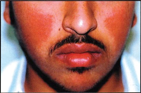 Erythromelanosis Follicularis Faciei First Case Report From Saudi