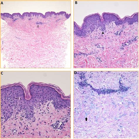 Skin Biopsy Findings A Hande 20× Punch Biopsy Of Skin Shows A