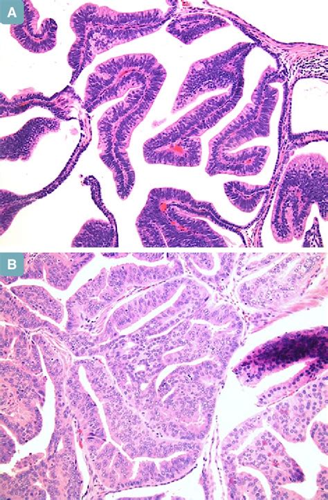 Prostatic Ductal Adenocarcinoma Ductal Pca Ductal Pca Showing Download Scientific Diagram