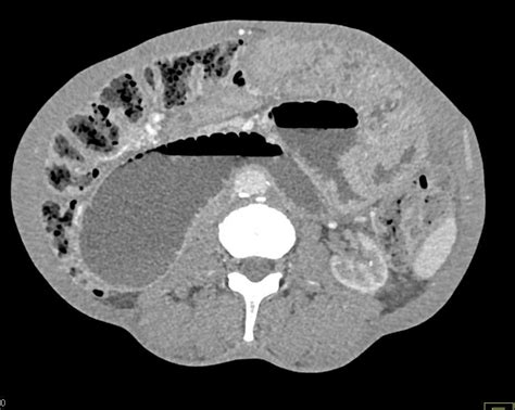 Small Bowel Obstruction Sbo With Adhesions Small Bowel Case Studies