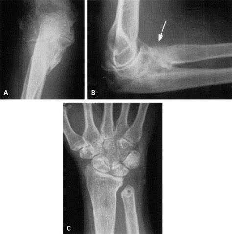 The Essex Lopresti Fracturedislocation Factors In Early Management And