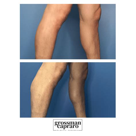 Gallery Of Calf Implants Grossman Capraro Plastic Surgery