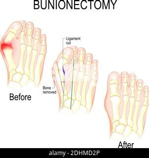 Deformidad En El Pie Humano Hallux Valgus Y Adapta El Juanete Imagen