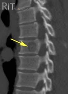 RiT radiology: Spinal Hemangioma