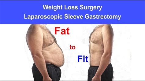 Laparoscopic Sleeve Gastrectomy Surgical Weight Loss Procedure Youtube