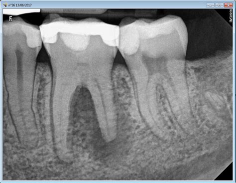 Saving a Severely Calcified Tooth with a Root Canal Procedure ...