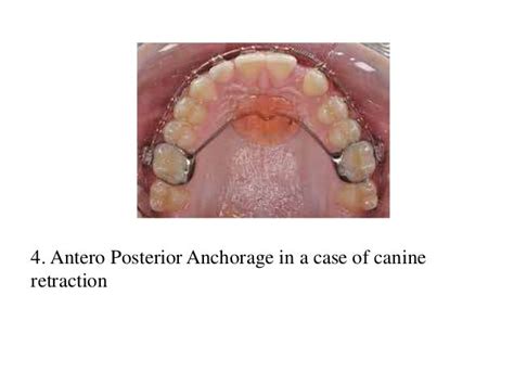 Trans Palatal Arch